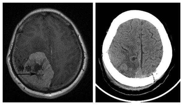 术前磁共振,提示右侧顶枕叶巨大肿瘤术后ct,提示肿瘤已切除病人已经在