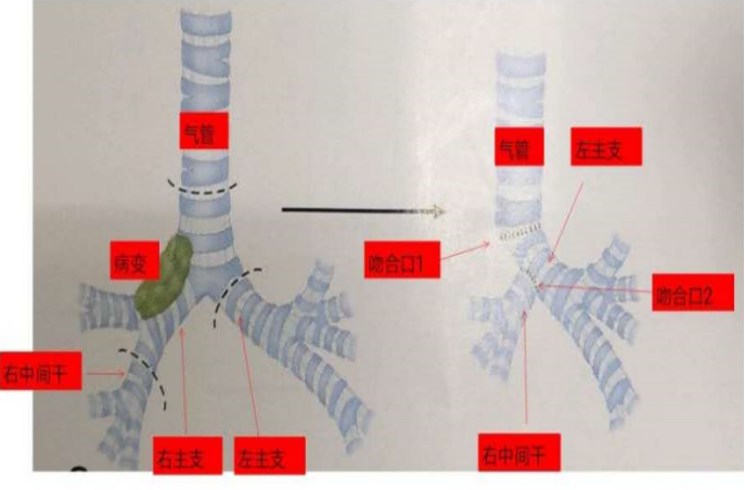 隆突重建气管成形术,解决特殊位置气管肿瘤难题