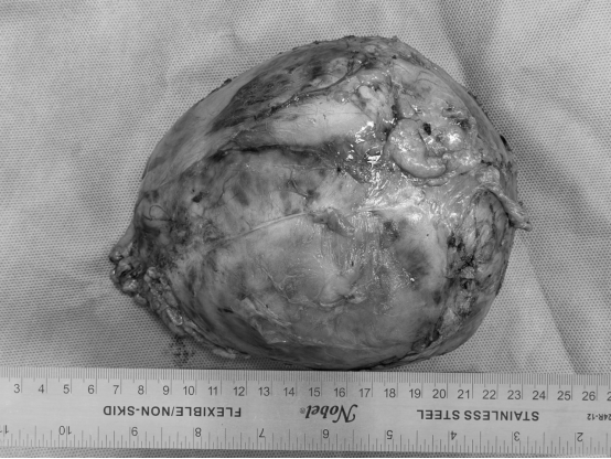 图2 肿瘤完整切除，肾脏得以保留.png